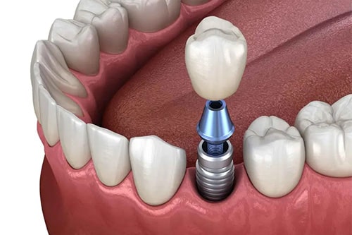 Dental implant diagram showing artificial tooth fixture inserted into jawbone with crown on top.