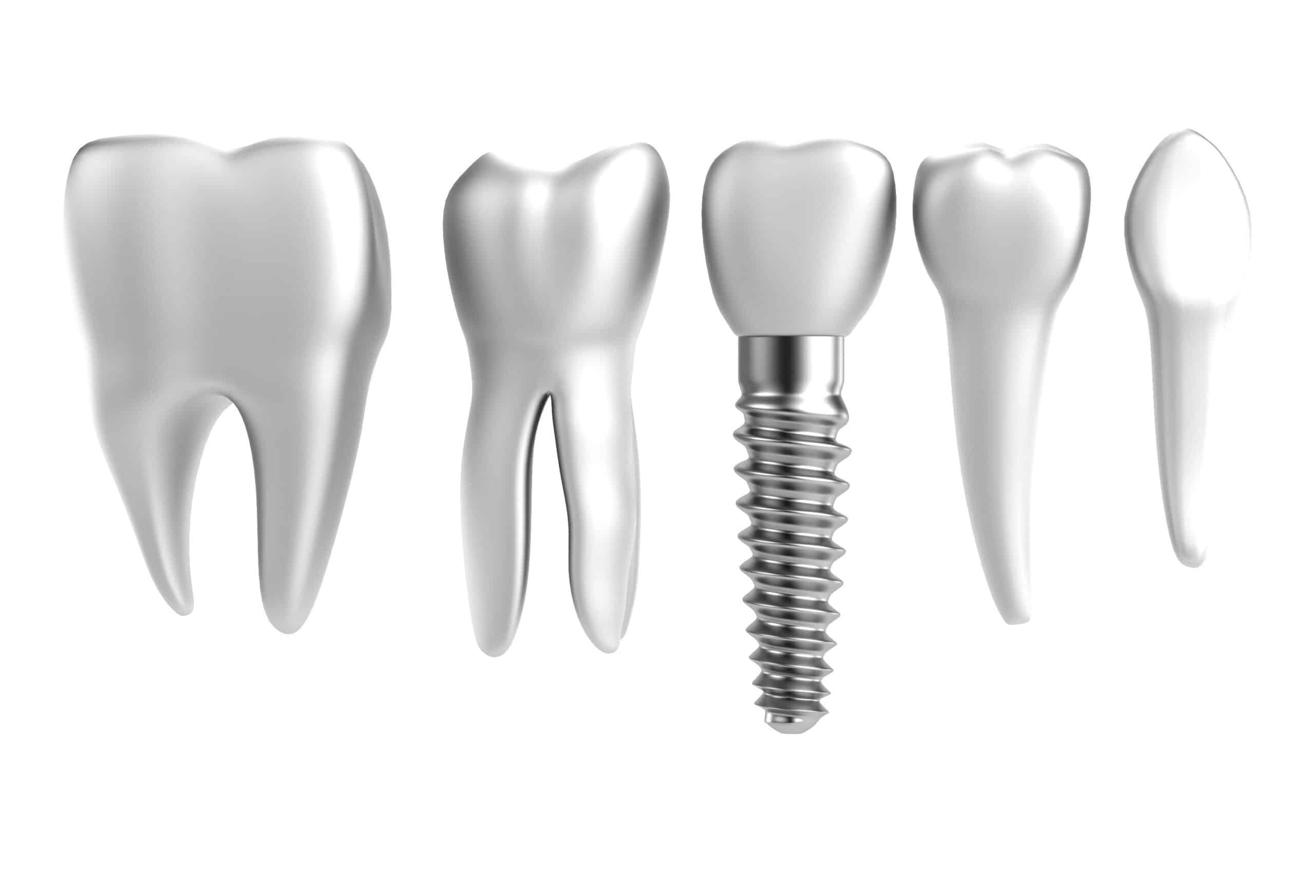 realistic 3d render of tooth implant