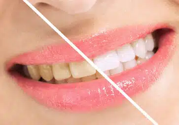 Before and after dental whitening comparison showing yellowed teeth transforming to bright white teeth.