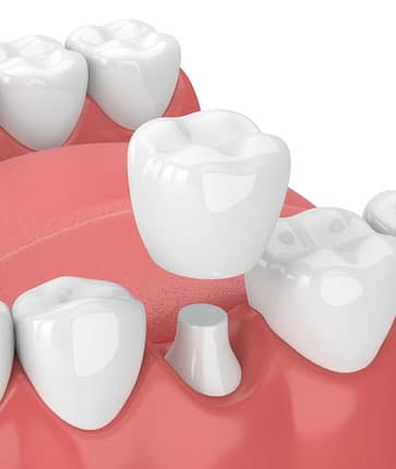 3D dental implant illustration showing tooth replacement in gum model with surrounding teeth.