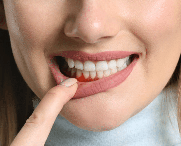 Close-up of person's smiling face showing healthy white teeth and pointing to lower lip.