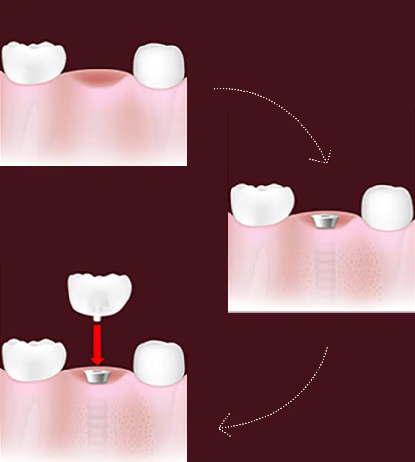 Dental implant placement procedure showing tooth extraction, implant insertion, and crown restoration steps.