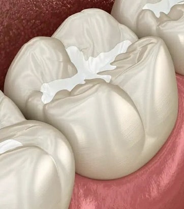 Close-up view of white dental model teeth showing molars on pink gum base