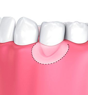 Dental illustration showing three white teeth with pink gum tissue and dotted surgical outline for graft procedure.