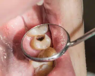 Dental mirror examining tooth cavity in patient's mouth during oral examination.