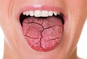 Close-up of swollen, cracked tongue with dry appearance showing oral health concern.