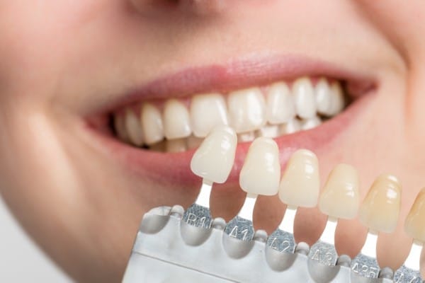 Person smiling comparing natural teeth with tooth shade guide samples for dental color matching.