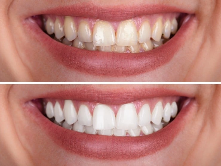 Before and after dental whitening comparison showing brightened teeth transformation at Danville Family Dental.