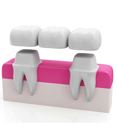 3D dental bridge model showing two tooth crowns on pink base with replacement teeth above.