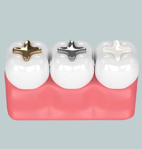 Three dental crowns with different metal bases displayed on pink model gum base.