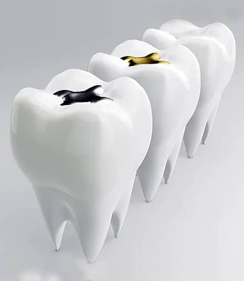 Three white tooth models in a row, two with dental fillings, representing restorative dental care.
