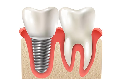 Dental implant cross-section diagram showing implant structure compared to natural tooth in jawbone.