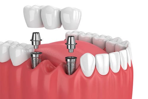 dental-implants