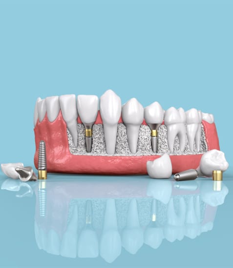 Dental implant model showing prosthetic teeth and implant components on blue background.