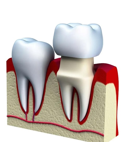 Cross-section diagram showing natural tooth and dental implant with crown in jawbone.