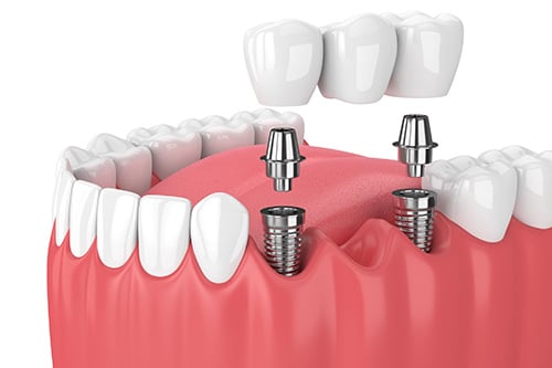 Dental implant diagram showing titanium posts and ceramic crowns in gum tissue model.