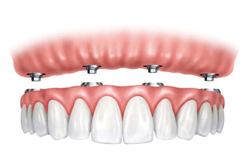 All-on-4 dental implants showing prosthetic teeth attached to implant posts in gum tissue.