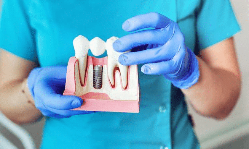 Dental Implants