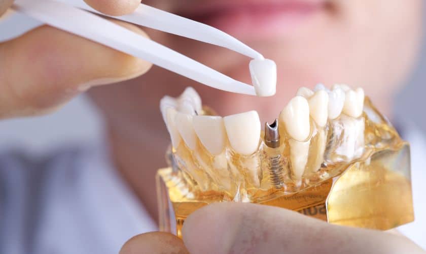 Dental Implants in Danville