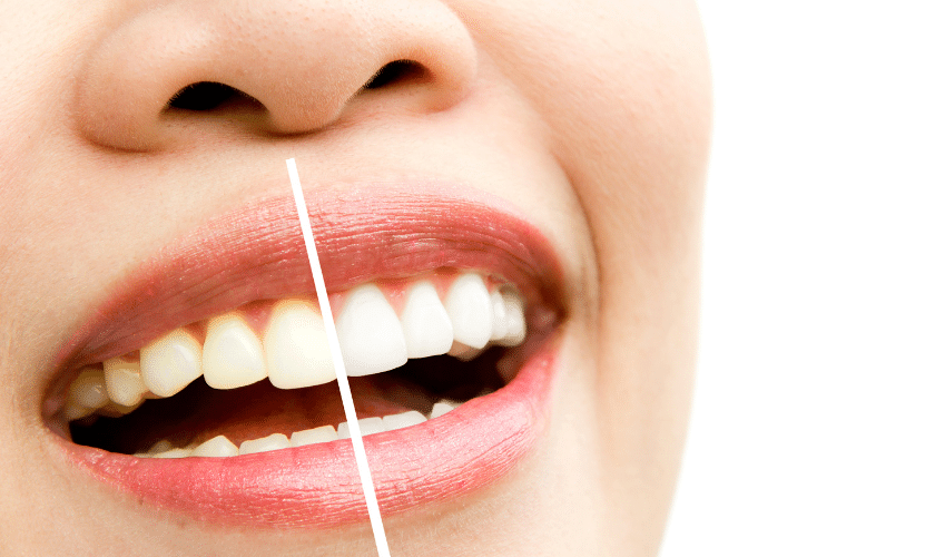 Featured image for “Teeth Whitening for Sensitive Teeth: How to Brighten Your Smile without Discomfort”