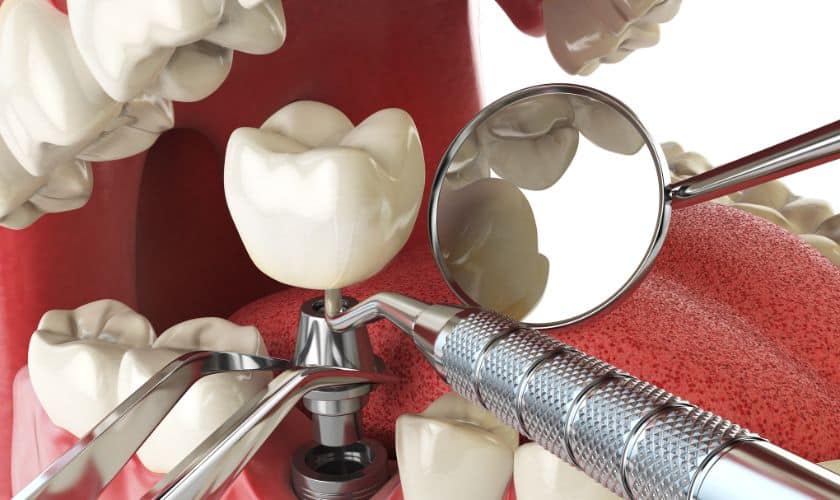 Dental Implants Danville