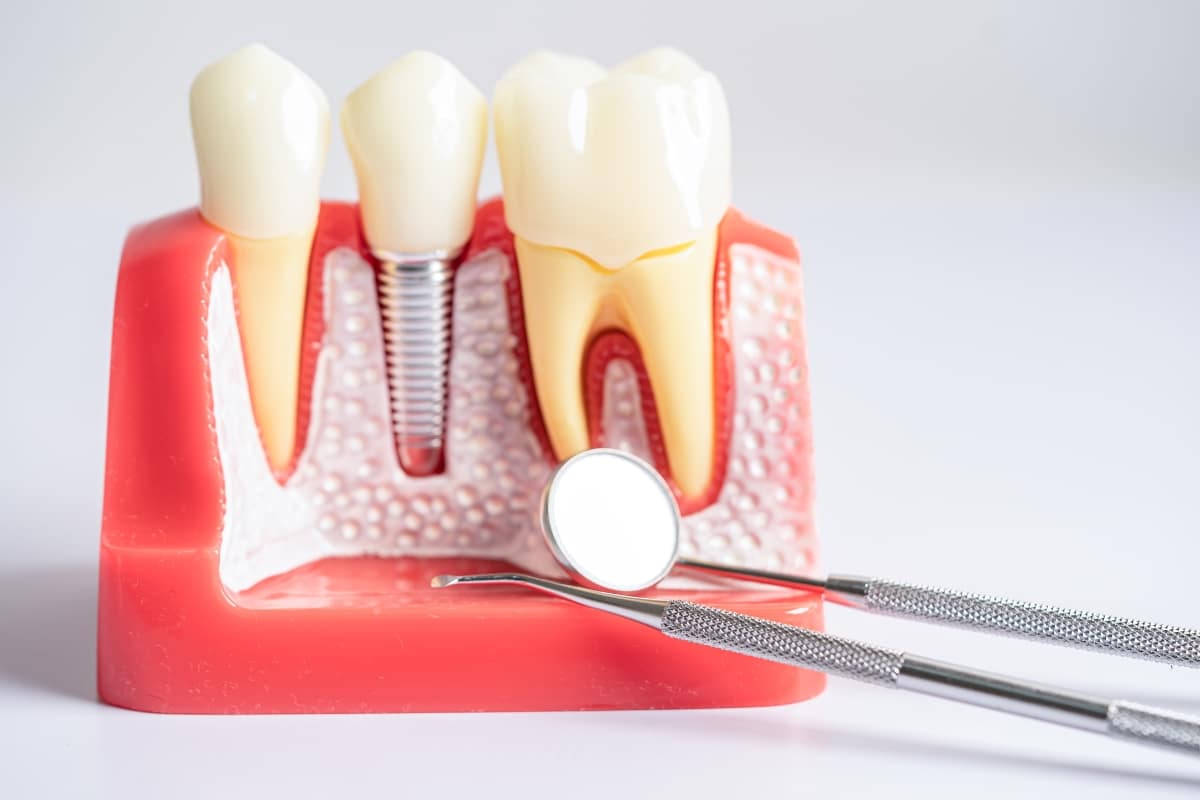 root canal