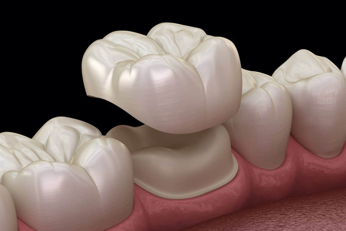 dental crowns Danville