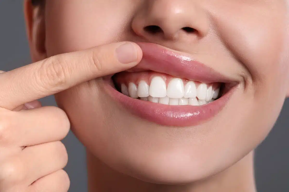 How To Get Rid of Gummy Smile Naturally